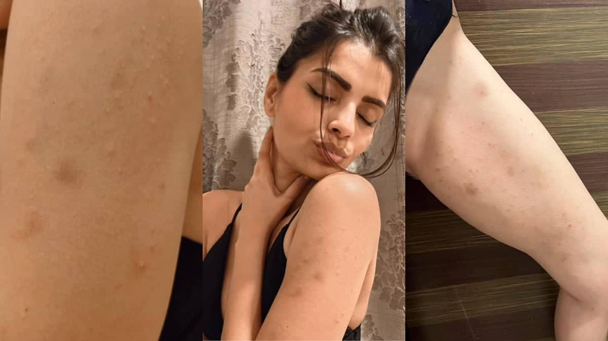 Sonali Raut Ka Bigg Boss Marathi 6 Mein Scabies Ka Shor